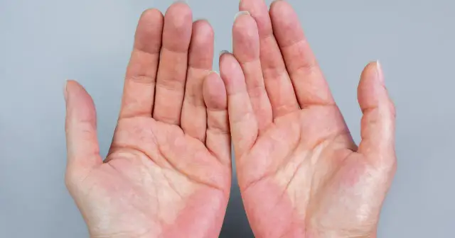 Czerwone dłonie od wewnątrz przyczyny: objawy, które mogą zaskoczyć