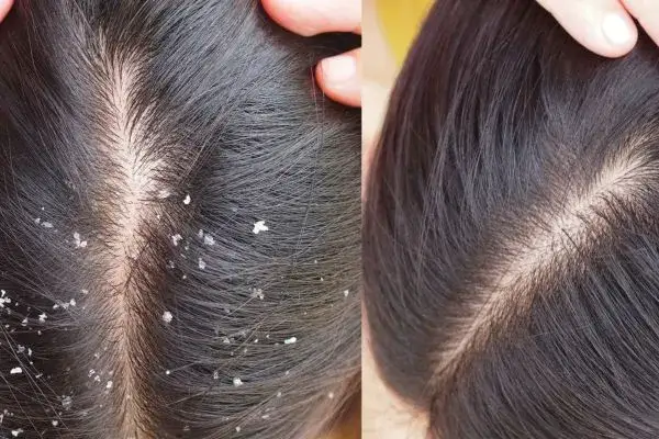 Skąd się bierze łupież? Odkryj przyczyny i jak ich uniknąć