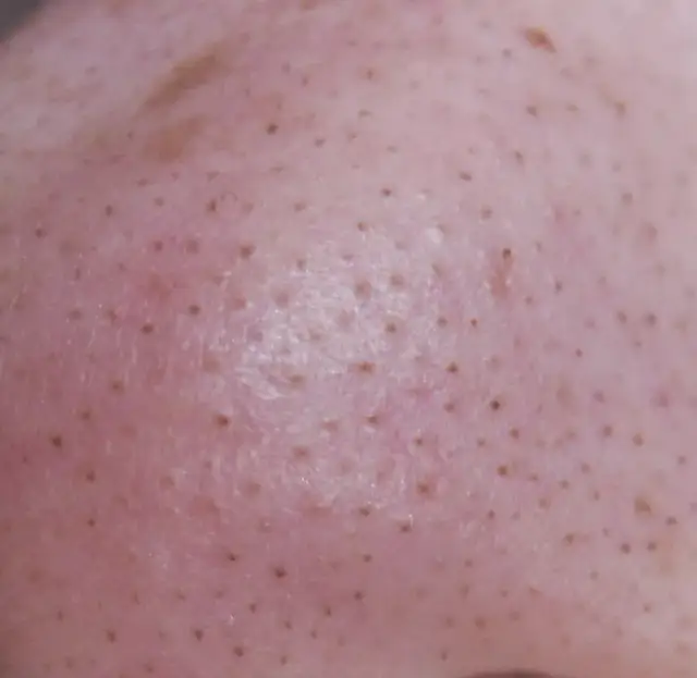 Jak wygląda zapchana cera i jak skutecznie z nią walczyć