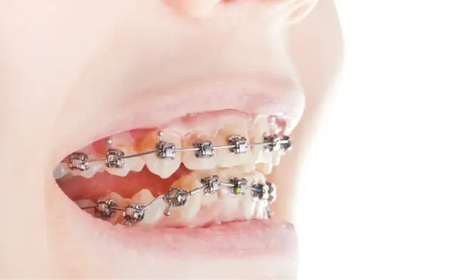 Jak długo trwa leczenie ortodontyczne? Czas, czynniki, efekty