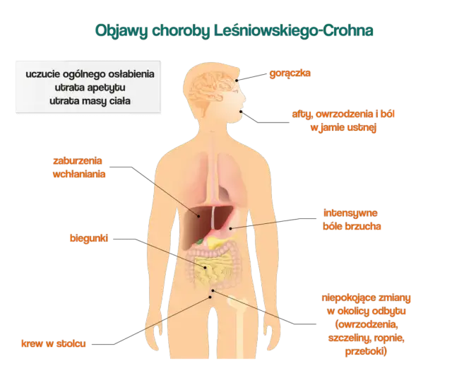 Choroba Leśniowskiego-Crohna: objawy w jamie ustnej, które musisz znać