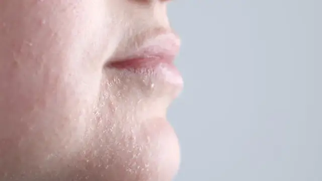 Zaburzona bariera hydrolipidowa - jak wygląda i jak ją rozpoznać