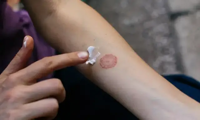 Jakie leki na grzybicę skóry pomogą Ci szybko i skutecznie?