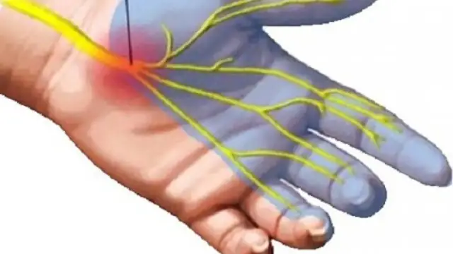 Zespół cieśni nadgarstka jaki lekarz - jak uniknąć błędnych wyborów