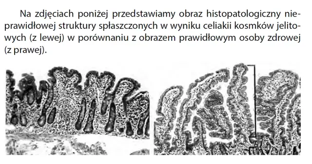 Celiakia jaki lekarz - jak nie popełnić błędu w diagnozie?