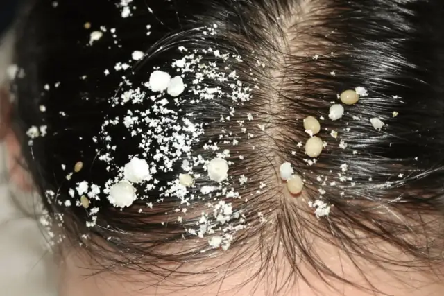 Wszawica u dziecka: Jak skutecznie sprawdzić i rozpoznać gnidy?