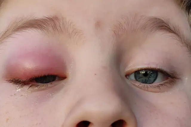 Obrzęk i zaczerwienienie powieki, jakby ktoś miał na coś uczulenie. Familiada pyta, na co można mieć uczulenie?