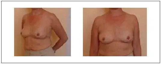 Jak wygląda pierś po operacji oszczędzającej? Przed i po zdjęcia