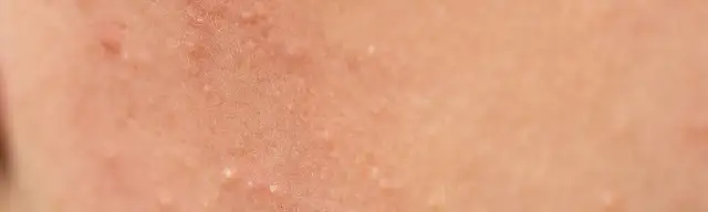 Jak wygląda zapchana cera i jak ją skutecznie wyleczyć?