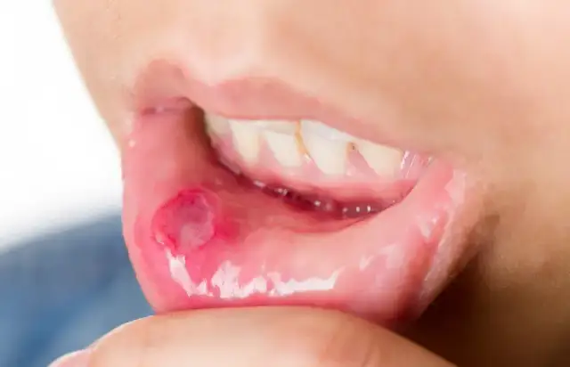 Jakiego lekarza wybrać przy chorobach błony śluzowej jamy ustnej?