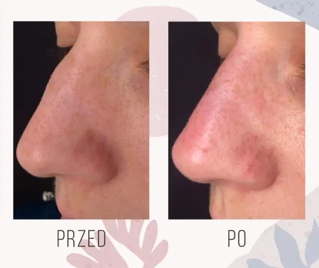 Jak zmniejszyć nos kwasem hialuronowym - efekty, ryzyko i przygotowanie