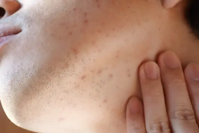 Blizny po pryszczach i przebarwienia: Jak skutecznie je usunąć?