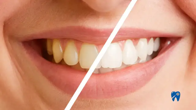 Piwo a przebarwienia zębów: Jak pić i zachować biały uśmiech?