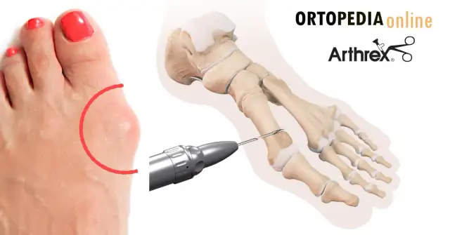 Operacja haluksów: kiedy jest konieczna i czy warto czekać?
