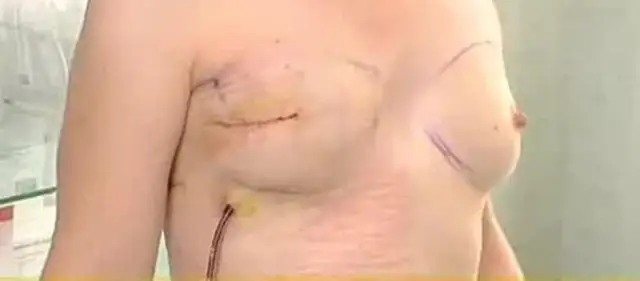 Gdzie wykonać profilaktyczną mastektomię na NFZ i uniknąć ryzyka?