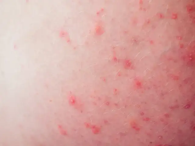 Pryszcze w miejscach intymnych – przyczyny, objawy i co robić?