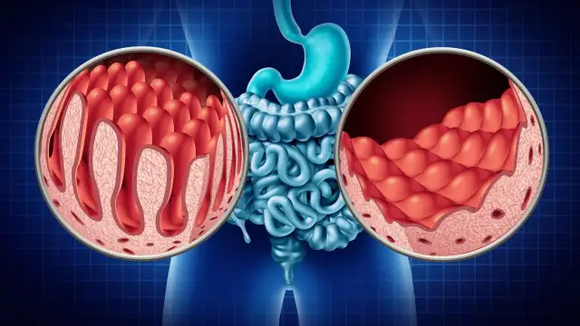 Ilustracja układu pokarmowego z powiększonymi wycinkami jelit: zdrowe kosmki jelitowe i uszkodzone.