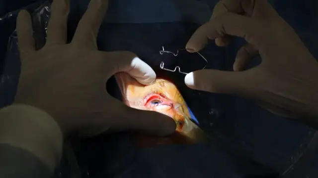 Czy po operacji zaćmy można oglądać telewizję? Oto ważne zalecenia