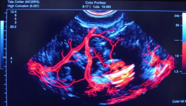 USG Doppler: Bezbolesne badanie przepływu krwi. Jak działa?
