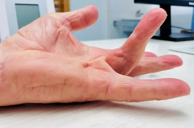 Przykurcz Dupuytrena: Do jakiego lekarza? Pełny przewodnik i diagnoza