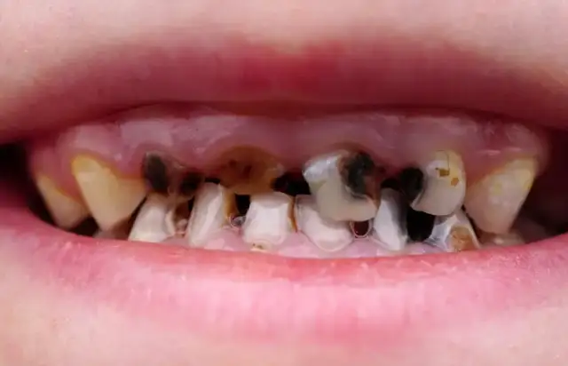 Jak wyleczyć próchnicę bez dentysty? Kiedy to możliwe?