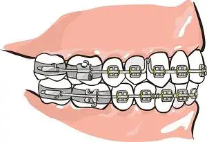 Jak prawidłowo włożyć drut do aparatu bez błędów i bólu – proste kroki
