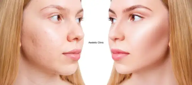 Jak szybko wyleczyć pryszcza? Skuteczne metody i uniknięcie blizn