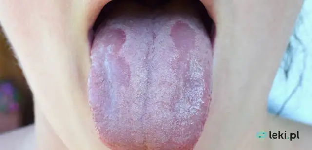 Grzybica jamy ustnej: Czy boli? Poznaj objawy i skuteczne leczenie