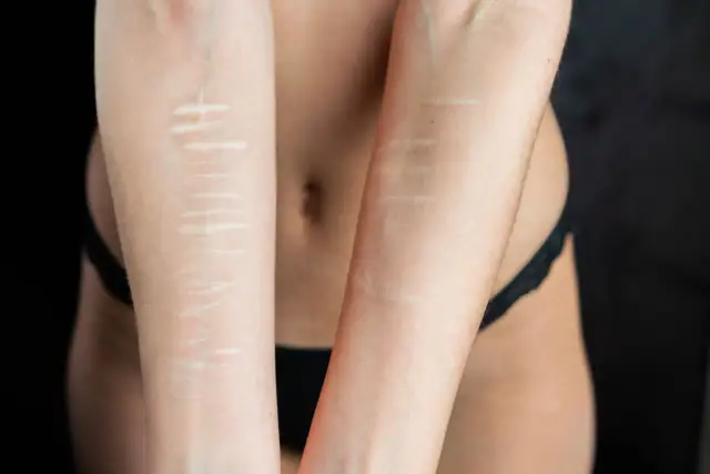 Pryszcze na plecach? Poznaj przyczyny i skuteczne metody leczenia "bacne"