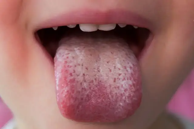 Grzybica jamy ustnej: Rozpoznaj, wylecz, zapobiegaj nawrotom!