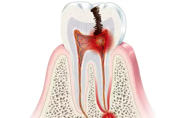 Czy ropień zęba sam pęknie? Ulga czy zagrożenie?