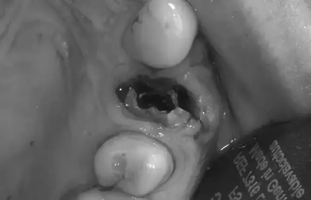 Wyrwanie zęba: Kiedy wyjść na dwór i uniknąć suchego zębodołu?