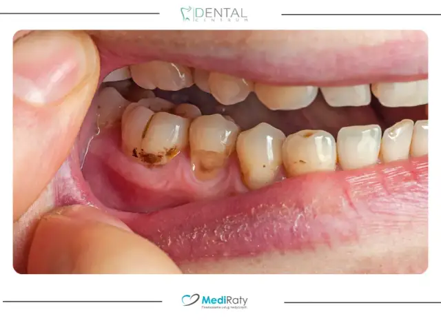 Domowe sposoby na próchnicę: Co naprawdę działa, zanim pójdziesz do dentysty?