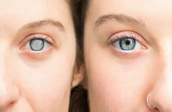 Jakie badania na wykrycie jaskry? Kluczowe testy dla zdrowia oczu