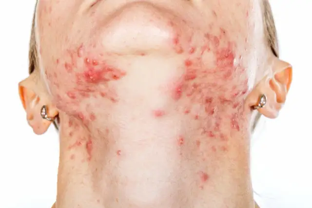 Pryszcze na szyi: Co Ci mówią? Przyczyny, mapa i jak z nimi walczyć