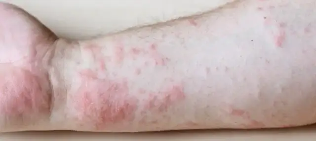 Jakie leki na rumień guzowaty skutecznie łagodzą objawy i ból