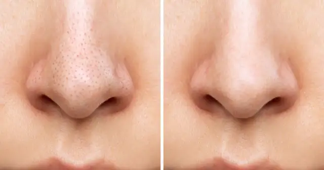 Jak usunąć pryszcza z nosa bez blizn i podrażnień skóry