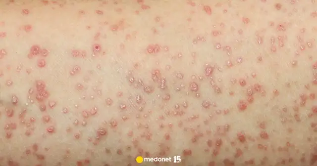 Liszaj płaski w ustach: objawy, przyczyny, leczenie i domowe sposoby