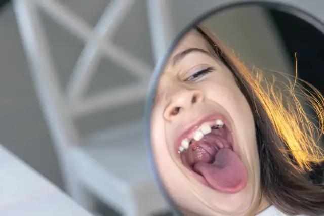 Czy zapalenie jamy ustnej jest zaraźliwe? Sprawdź, co musisz wiedzieć