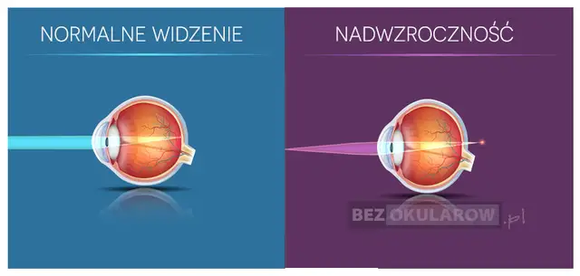 Plusy na recepcie? Zrozum dalekowzroczność i jak ją korygować