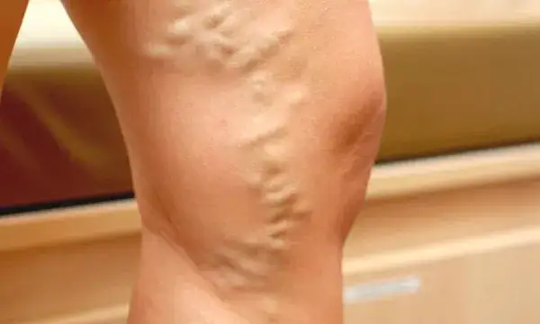 Jak nazywa się lekarz od żylaków nóg i jak może pomóc?