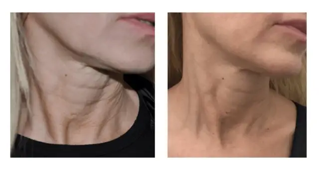 Przed i po zabiegach na szyję: widoczna poprawa napięcia skóry i redukcja zmarszczek na szyi.
