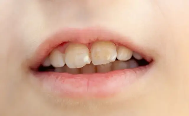 Jak wyleczyć próchnicę bez dentysty? Co możesz, a czego nie!