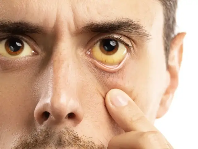 Zespół Gilberta a psychika: Zmęczenie, lęk, mgła mózgowa?