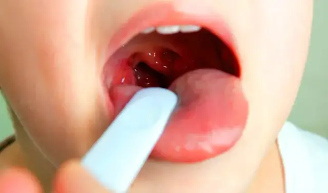 Jak rozpoznać ból gardła u niemowlaka - objawy, które musisz znać