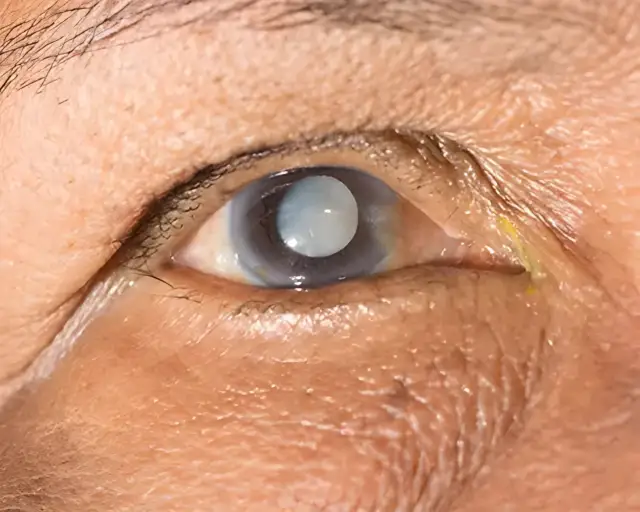 Grauen Star Symptome: Erkennen Sie die Anzeichen rechtzeitig