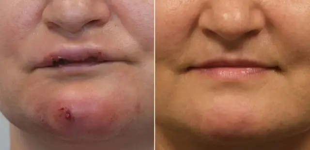 Kwas hialuronowy: Czy szkodzi? Poznaj fakty i uniknij powikłań.