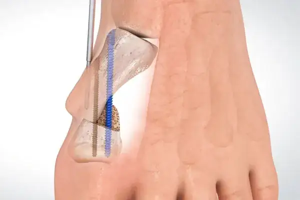 Znieczulenie do operacji haluksa: Wybierz komfort i bezpieczeństwo