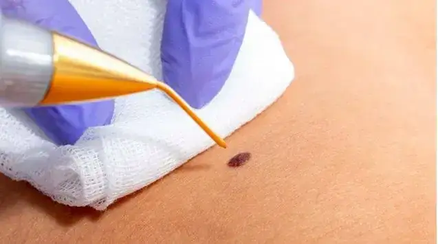 Usuwanie pieprzyka: Jakiego specjalistę wybrać dla zdrowia i estetyki?