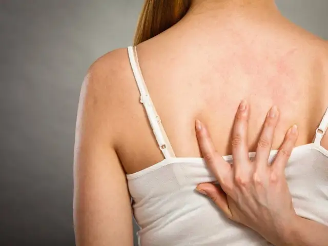 Pryszcze na plecach: Co naprawdę działa? Kompletny poradnik Mariki Tomaszewskiej